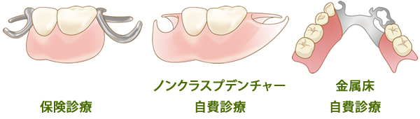 部分入れ歯の種類