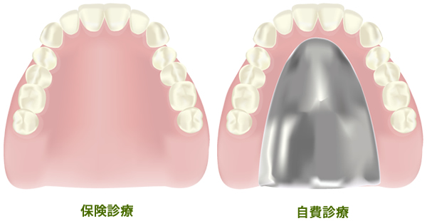 総入れ歯の種類